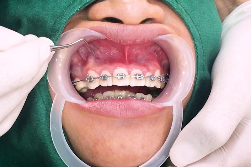 Phẫu thuật kết hợp với niềng răng để chữa hô hàm hiệu quả tối ưu