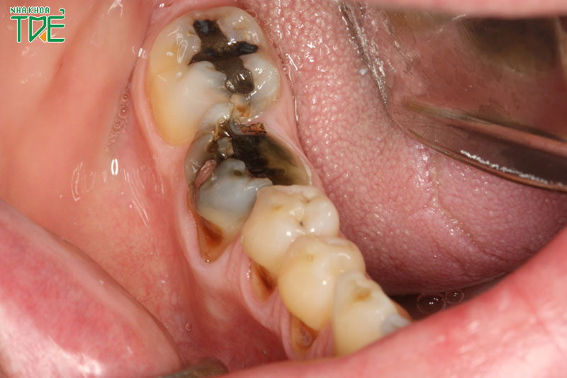 Viêm tủy lan rộng có nguy cơ làm mất răng