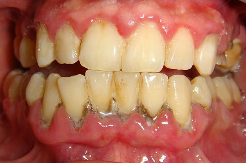 Lấy cao răng định kỳ tránh cao răng tích tụ quá nhiều gây bệnh răng miệng