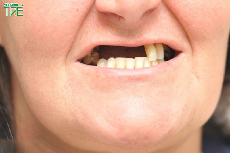 Mất răng gây lệch hàm và nhiều biến chứng nguy hiểm khác