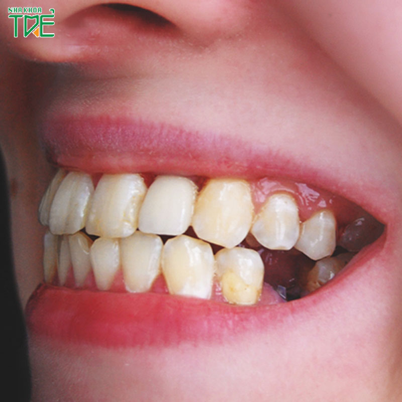 Mất răng hàm bị hóp má không? Giải pháp nào phục hình răng hiệu quả