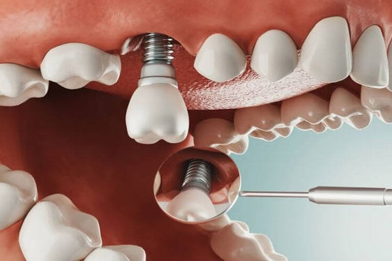 Trồng răng Implant - Phương pháp phục hình tối ưu ngăn ngừa tiêu xương