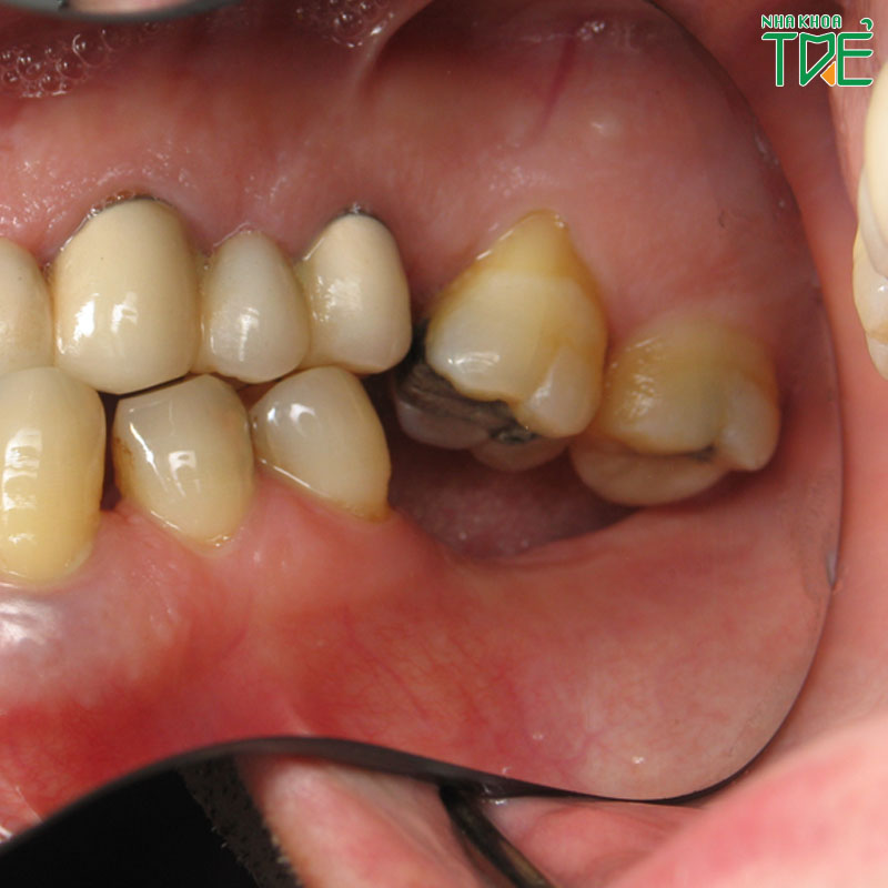 Mất răng hàm số 7 có sao không? Trồng Implant phục hình răng tối ưu