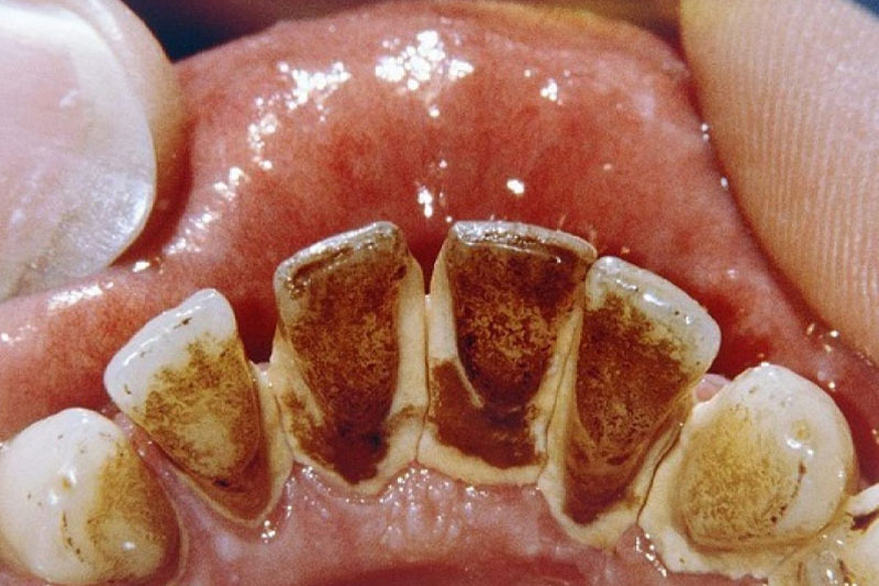 Cao răng cứng đầu ở chân răng là thủ phạm làm mòn cổ chân răng