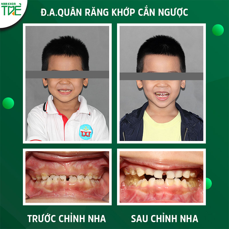 Niềng răng khớp cắn ngược cho trẻ là rất cần thiết để bảo vệ sức khỏe răng miệng