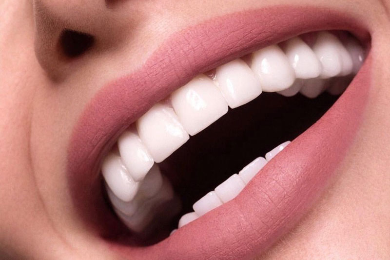Sau niềng răng bạn sẽ sở hữu hàm răng đều đẹp, thẳng hàng