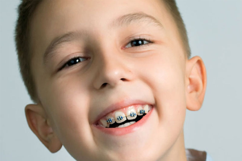 Niềng răng cho trẻ sẽ mang lại hiệu quả cao hơn người trưởng thành