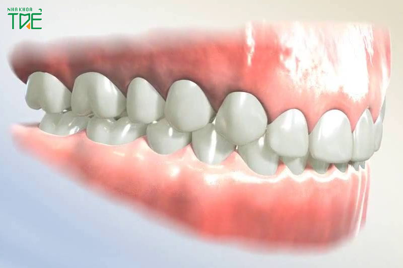 Niềng răng xong bị khớp cắn sâu có thể xảy ra do niềng răng thất bại
