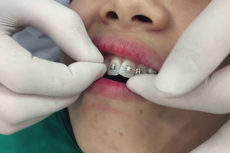 Thực hiện niềng răng sai kỹ thuật sẽ tác động tiêu cực lên cấu trúc hàm