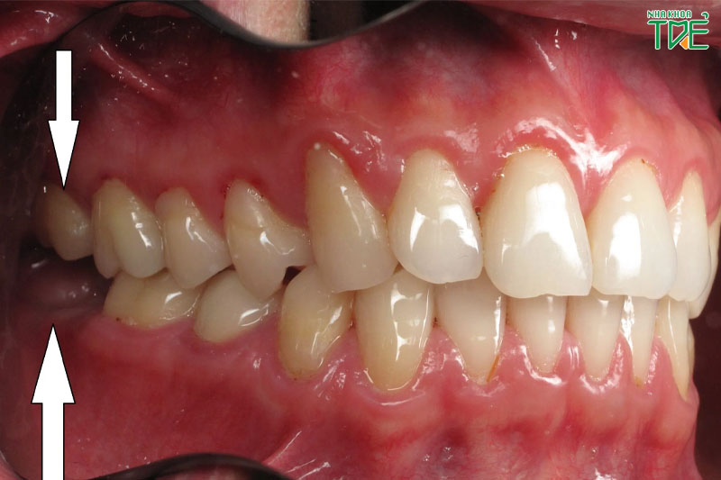 Răng hàm bị lung lay do nhiều nguyên nhân khác nhau