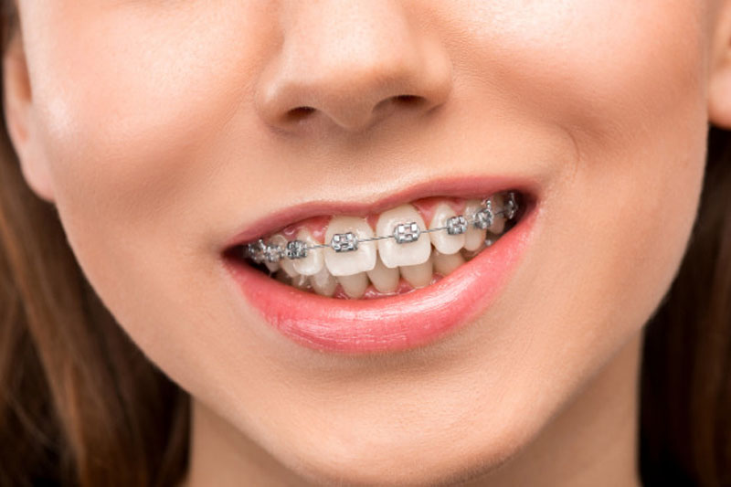 Niềng răng - giải pháp điều trị hiệu quả tình trạng răng hô nhẹ đến nặng