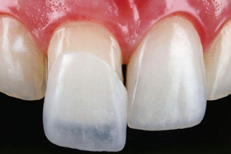Bọc răng sứ sẽ phải tác động đến men răng thật