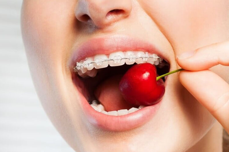 Niềng răng cần chú trọng chế độ ăn uống hàng ngày