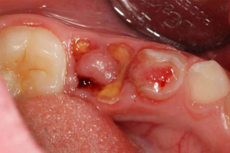 Nướu lợi lấn vào chân răng bị sâu hỏng