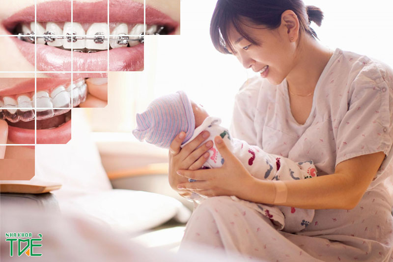 Sau sinh bao lâu thì niềng răng được? Một số lưu ý quan trọng cho mẹ sau sinh