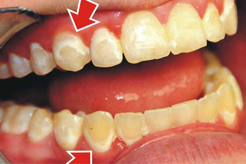 Tái khoáng răng giúp răng khỏe mạnh hơn, ngăn ngừa ê buốt răng