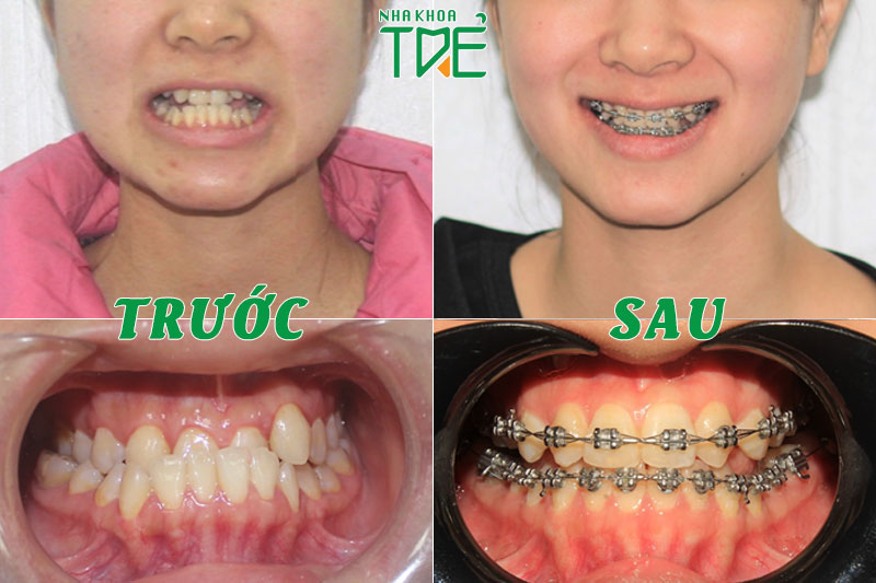 Hai hàm răng cân xứng và các răng thẳng hàng sau chỉnh nha