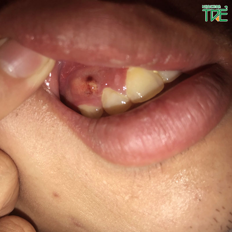 Chân răng có mủ: Dấu hiệu cảnh báo bệnh lý nguy hiểm