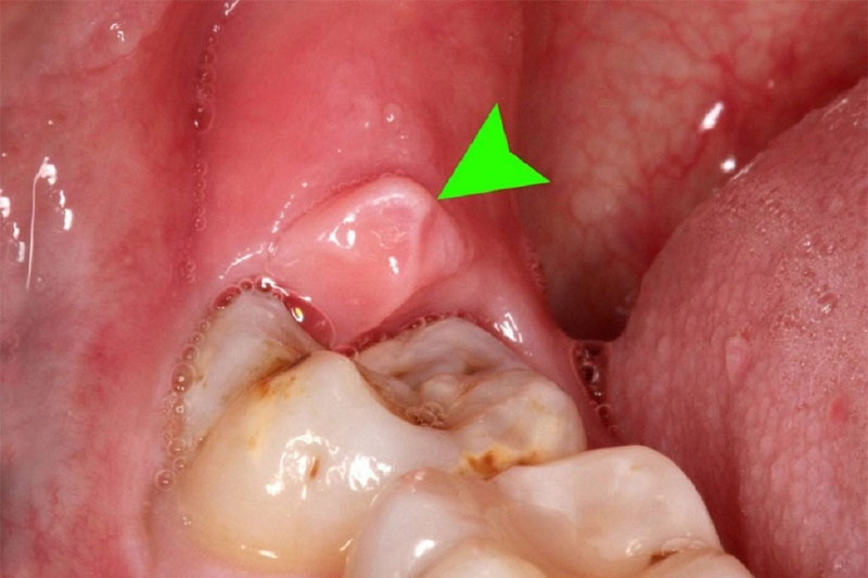 Viêm lợi ở răng hàm: Cảnh báo dấu hiệu mọc răng khôn nguy hiểm