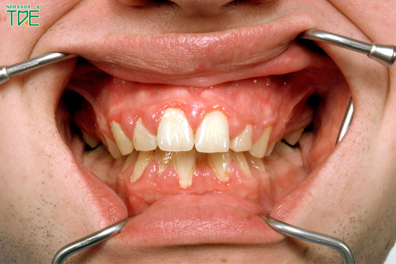 Viêm nướu buốt răng gây ra nhiều vấn đề răng miệng