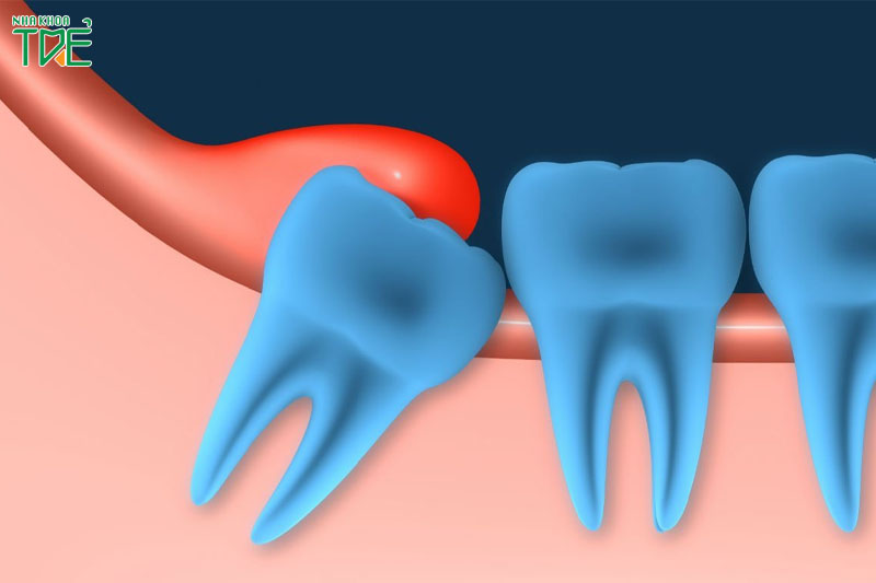 Viêm quanh thân răng là tình trạng phổ biến khi mọc răng khôn