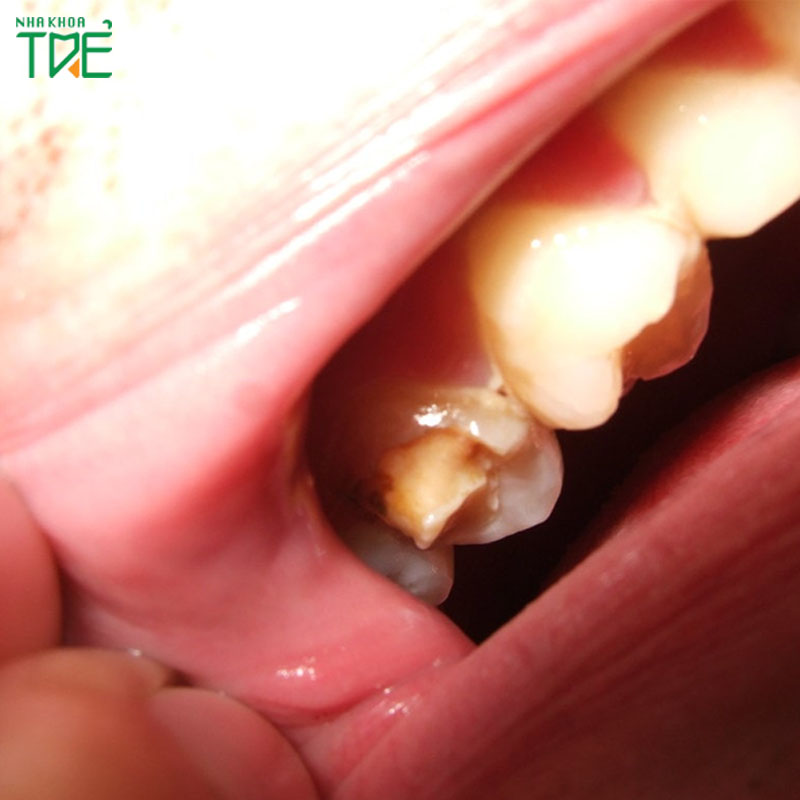 Bị vỡ chân răng do nguyên nhân nào? Cách khắc phục ra sao?