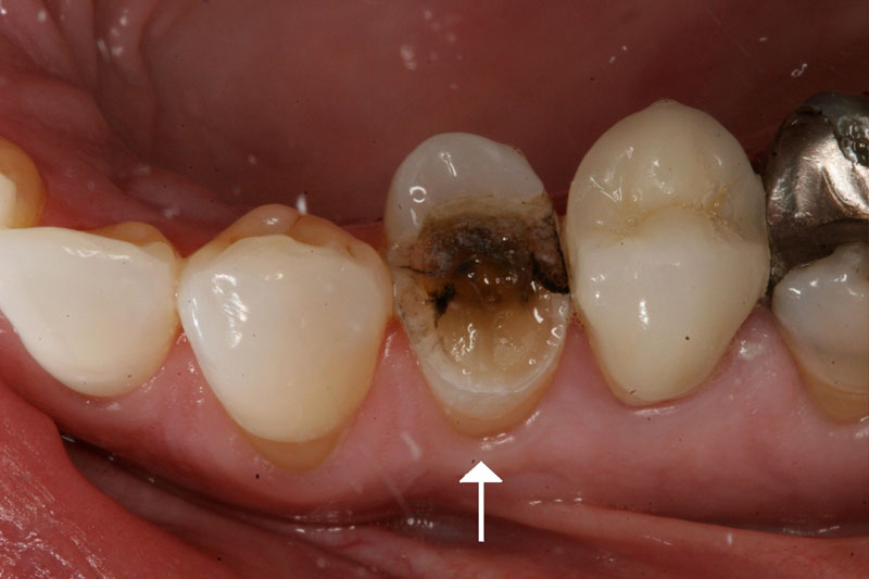 Bệnh sâu răng khiến răng bị gãy vỡ