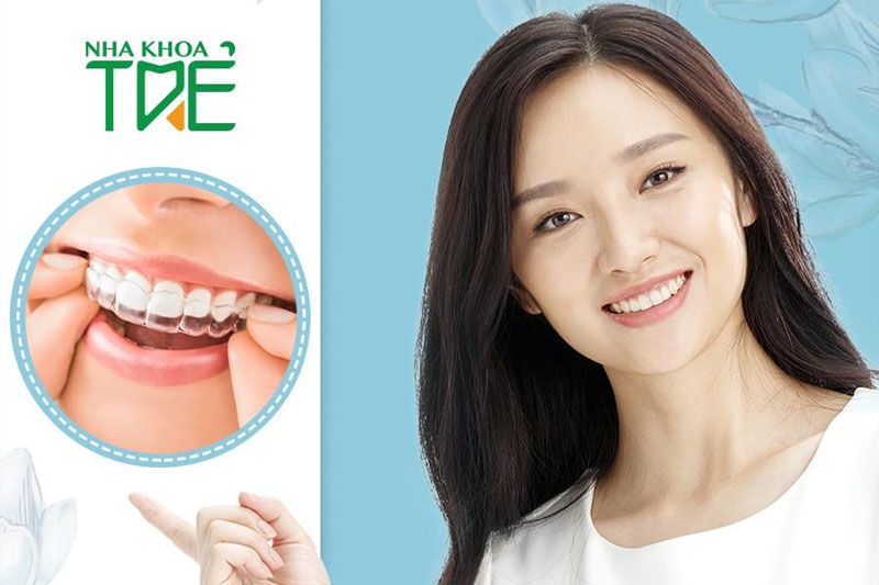 Niềng răng Invisalign - lựa chọn chỉnh nha tối ưu cho bạn