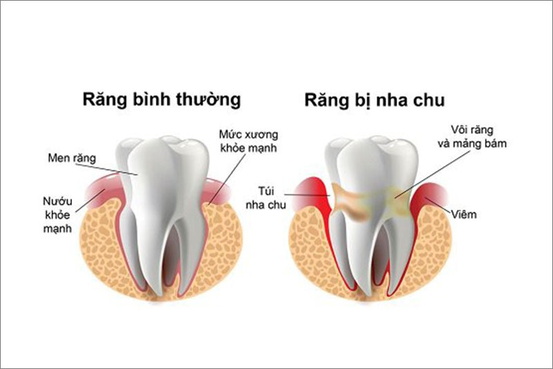 Nha chu là một trong những vấn đề sức khỏe răng miệng phổ biến
