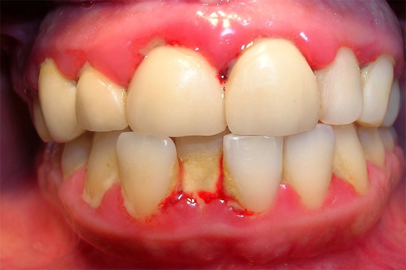 Mảng bám tích tụ trên răng là nguyên nhân chủ yếu gây ra bệnh nha chu