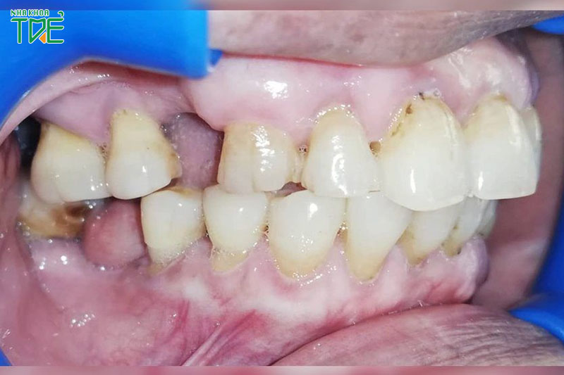 Nguy cơ mất răng do viêm nhiễm lan rộng sang mô quanh răng