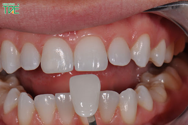Có nên bọc răng sứ cho răng cửa bị hô không?