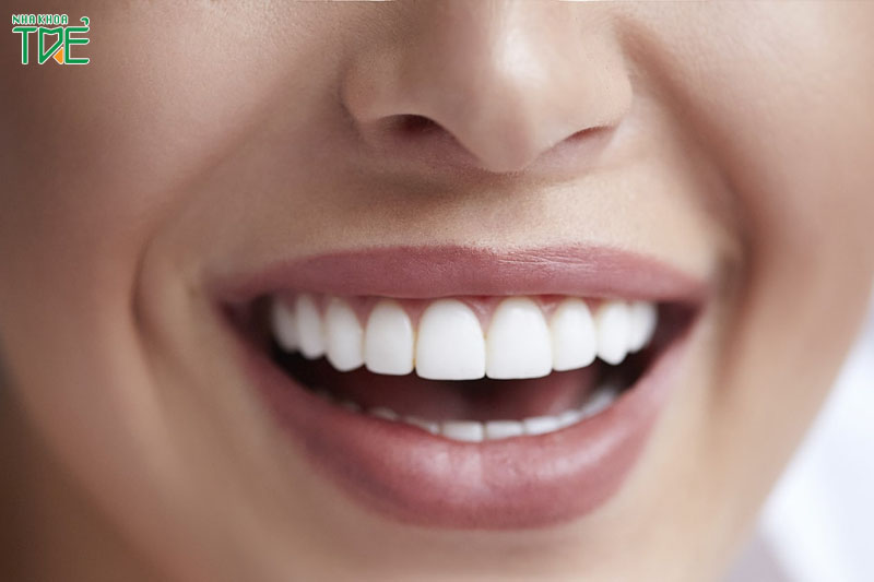 Bọc răng sứ cho răng cửa với màu sắc trắng sáng tự nhiên