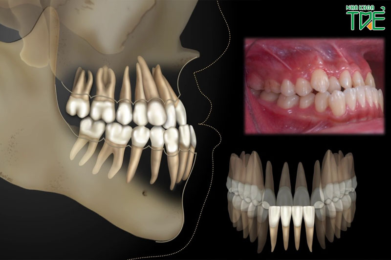 Trường hợp sai khớp cắn ở trẻ cần niềng răng để khắc phục triệt để