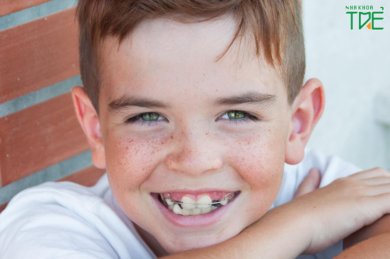 Niềng răng bằng khí cụ tháo lắp cho trẻ đang thay răng sữa