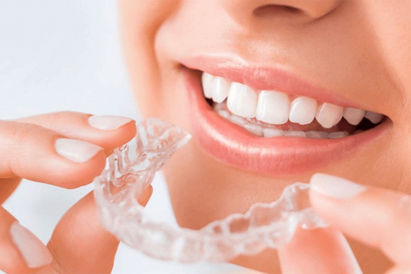 Niềng răng trong suốt Invisalign là phương pháp chỉnh hàm lệch tại nhà hiệu quả