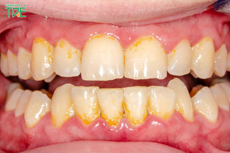 Cao răng cấp độ 2 với mảng dày và có màu vàng sẫm gây mất thẩm mỹ