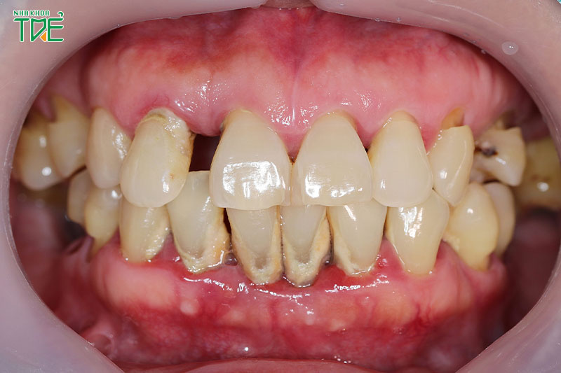 Bệnh lý viêm nha chu do cao răng gây ra rất nghiêm trọng, có thể gây mất răng