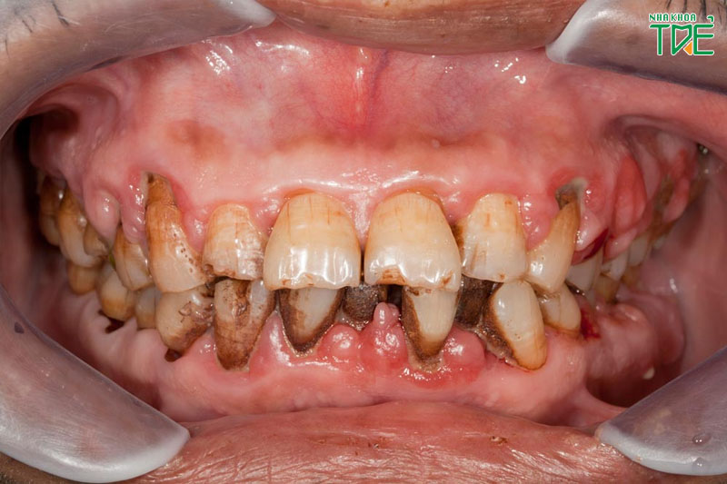 Cao răng nghiêm trọng sẽ gây ra nhiều bệnh lý nguy hiểm