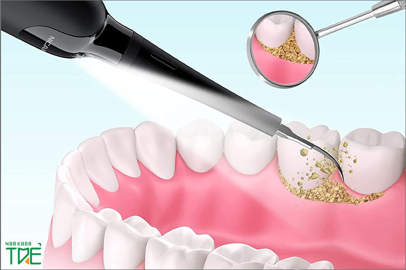 Lấy cao răng công nghệ siêm âm dễ dàng làm sạch cao răng dày cứng