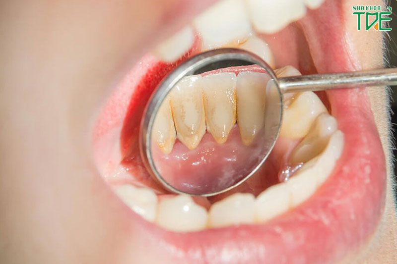Cao răng có mấy cấp độ và cách xử lý như thế nào?