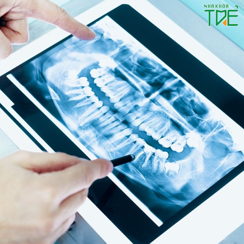 Chụp X-quang răng khi niềng răng có cần thiết không?