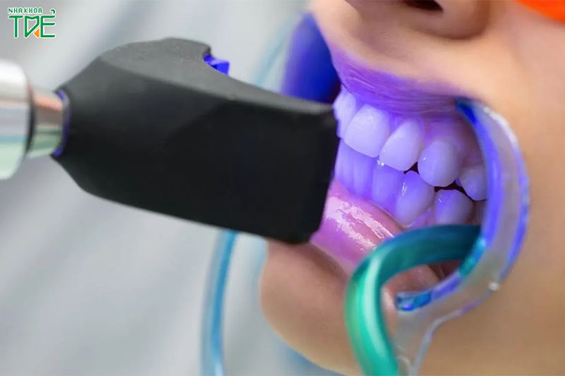 Tẩy trắng răng tại nha khoa để sở hữu hàm răng trắng sáng