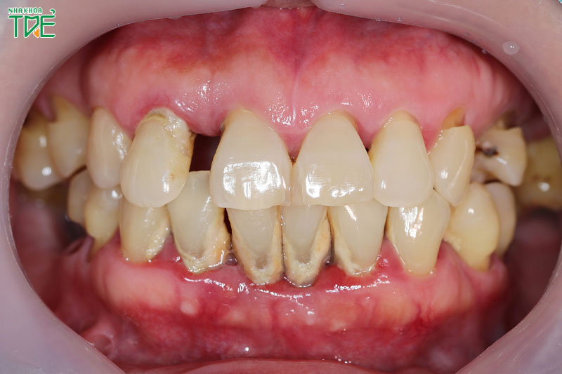 Chống chỉ định tẩy trắng răng với các trường hợp viêm nha chu, mòn cổ răng