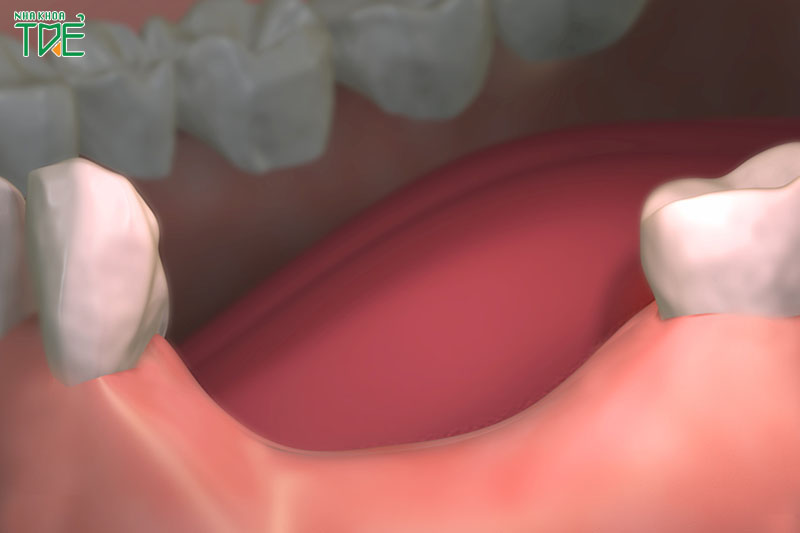 Tình trạng tiêu xương hàm diễn ra sau một thời gian mất răng
