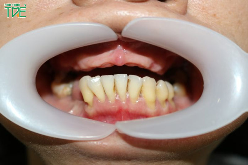 Mất răng toàn hàm không nên thực hiện ghép xương răng