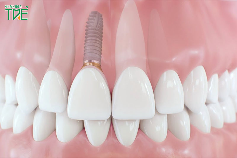 Phục hình răng từ chân răng với Implant sẽ ngăn ngừa được biến chứng tiêu xương hàm