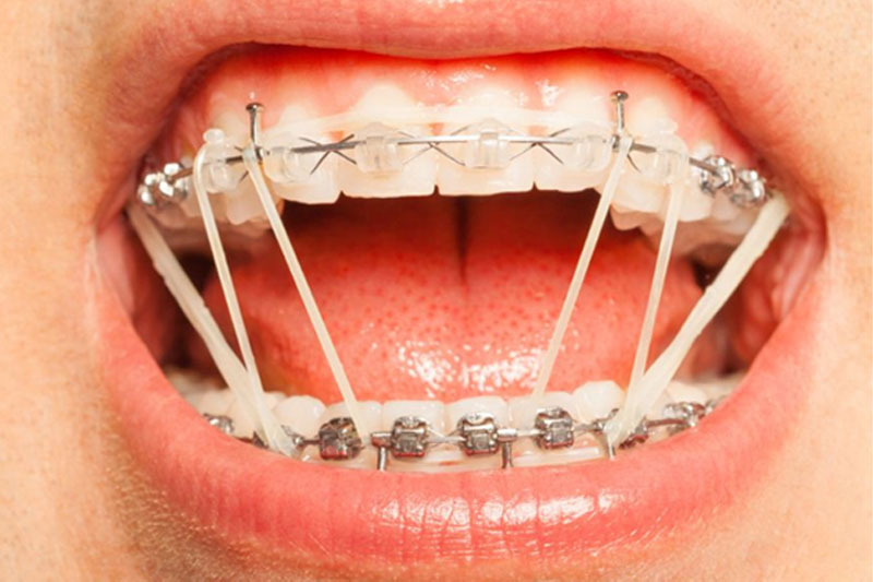 Niềng răng mắc cài để hàm răng trở nên cân đối, hài hòa