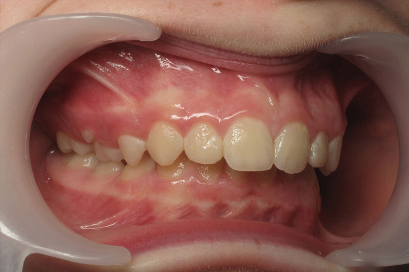 Cắn sâu khiến hàm trên bao phủ toàn bộ hàm răng dưới