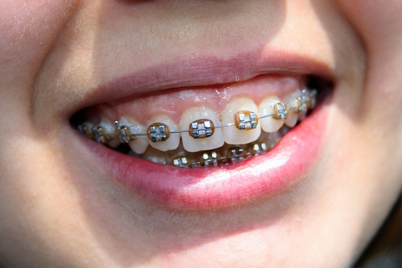 Niềng răng khớp cắn sâu để điều chỉnh những sai lệch trên răng